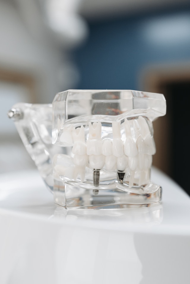implanty zębów - dobra alternatywa