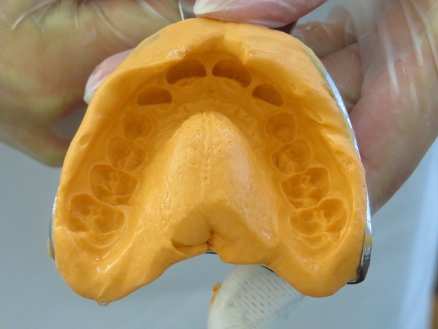 proteza zębowa całkowita