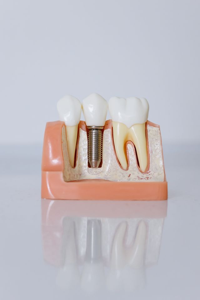Czy implant zęba można założyć od razu po usunięciu zęba?